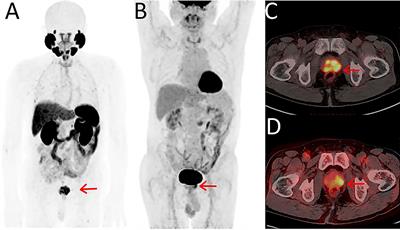 Clinical advancement of precision theranostics in prostate cancer